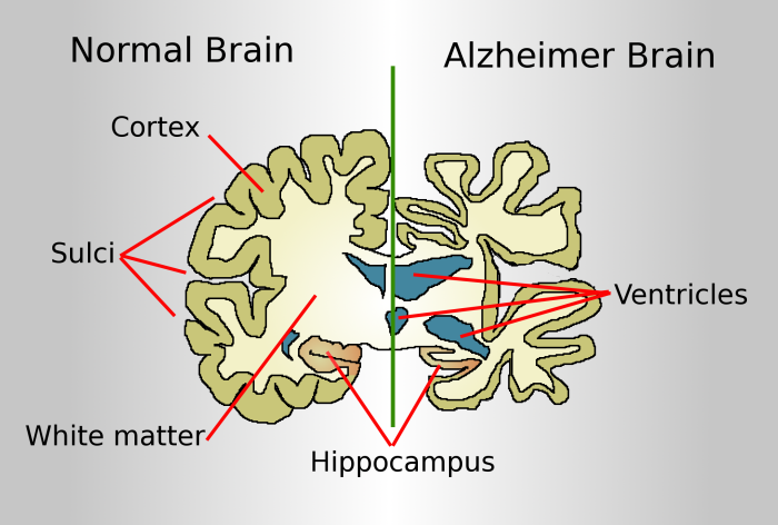 Alzheimer's Brain